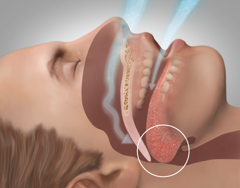 Obstructive Sleep Apnea